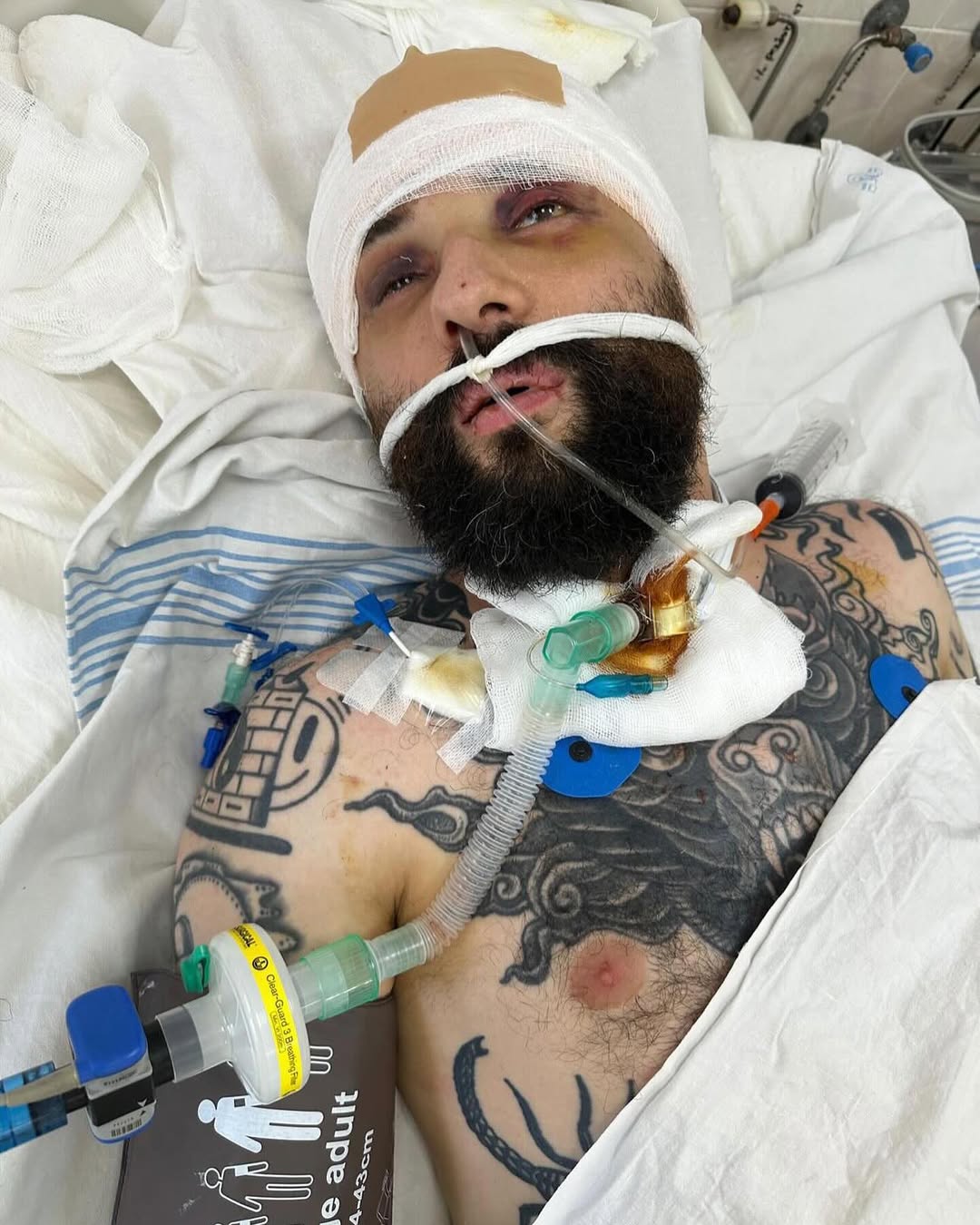 Віктор Розовий зробив перші кроки після поранення на фронті: зворушливе відео