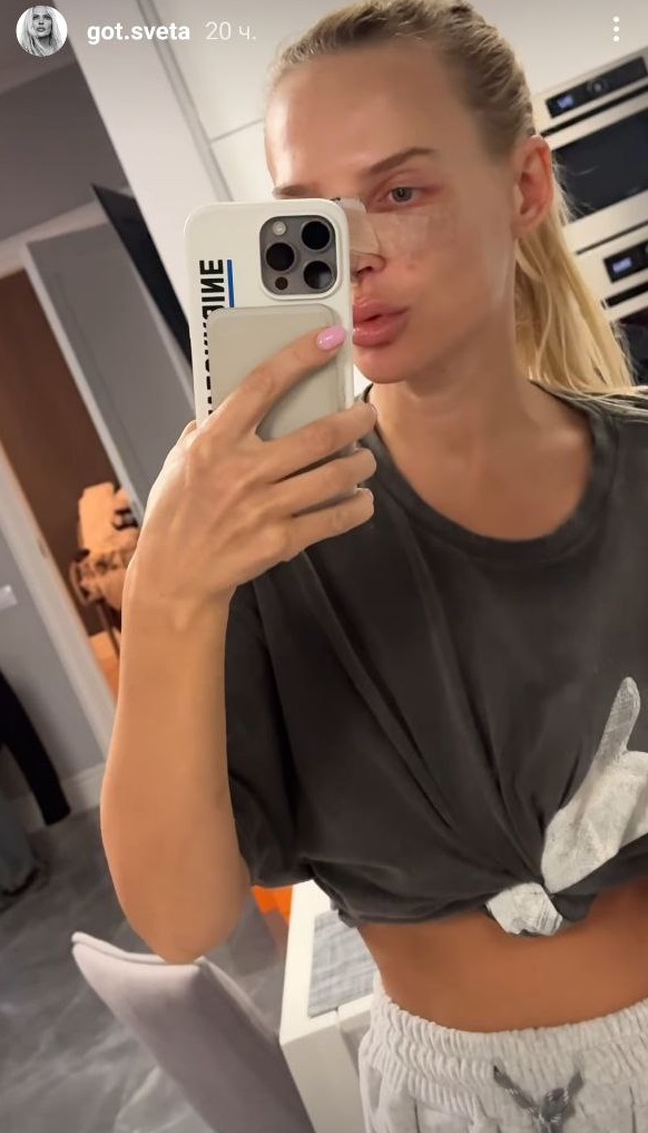 На тлі чуток про розрив: обраниця Цимбалюка зробила "пластику" та висловилася про актора