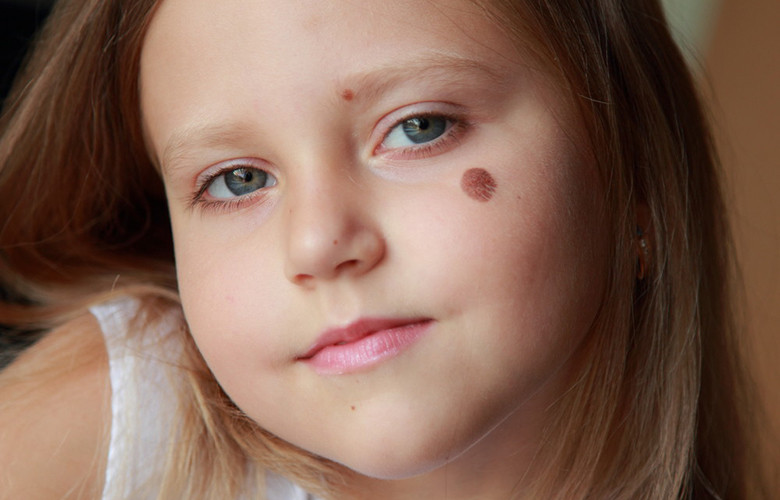 Родинки у детей: какие из них вас должны насторожить