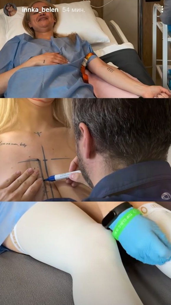 Інна Бєлєнь після "Холостяка" зробила "пластику" грудей і підборіддя