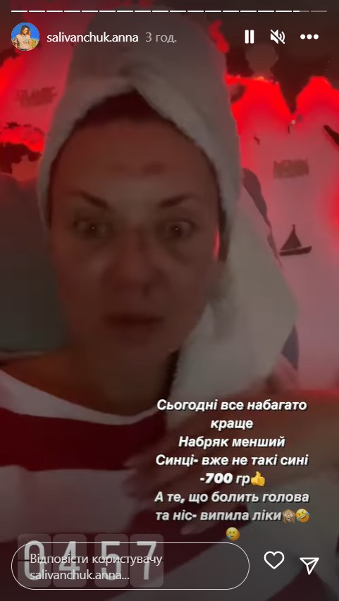 Зірка "Квартала 95" Саліванчук жахнула фото після перелому носа і струсу мозку