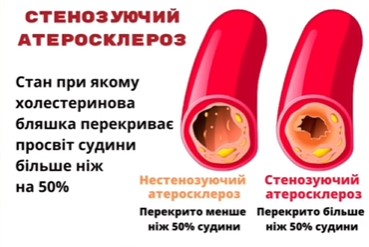 Як правильно "чистити" судини? Кардіолог назвала спосіб, який справді допомагає