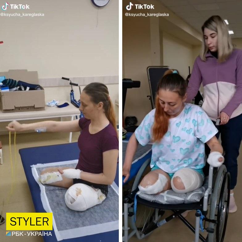 Медсестра из Лисичанска лишилась ног и части руки: теперь она звезда соцсетей и вдохновляет других