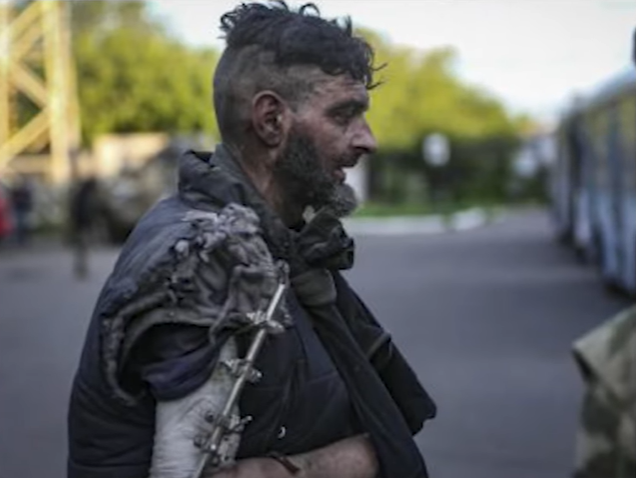 Герой Маріуполя після полону не має 4 см кістки в руці. Українці розпочали збір на лікування (фото)