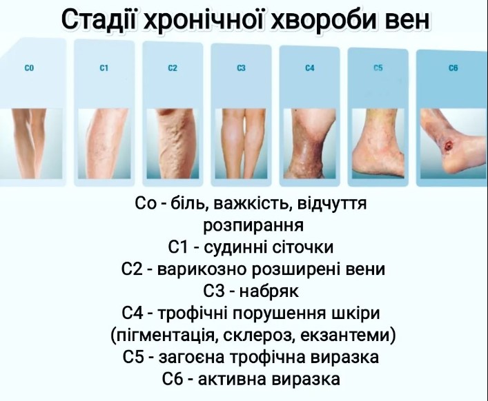 Як побороти варикоз на ногах. Лікар назвав дієві способи для різних стадій