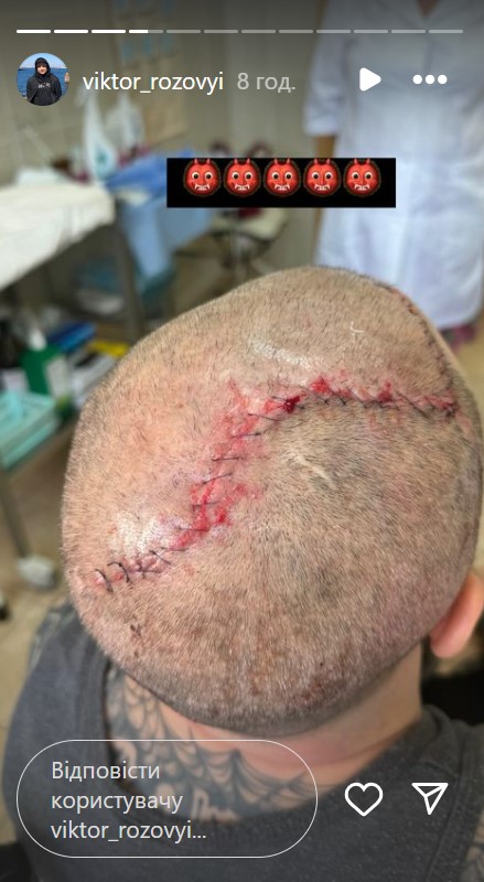 Комік Віктор Розовий розкрив подробиці реабілітації та пригадав бій перед пораненням (фото)