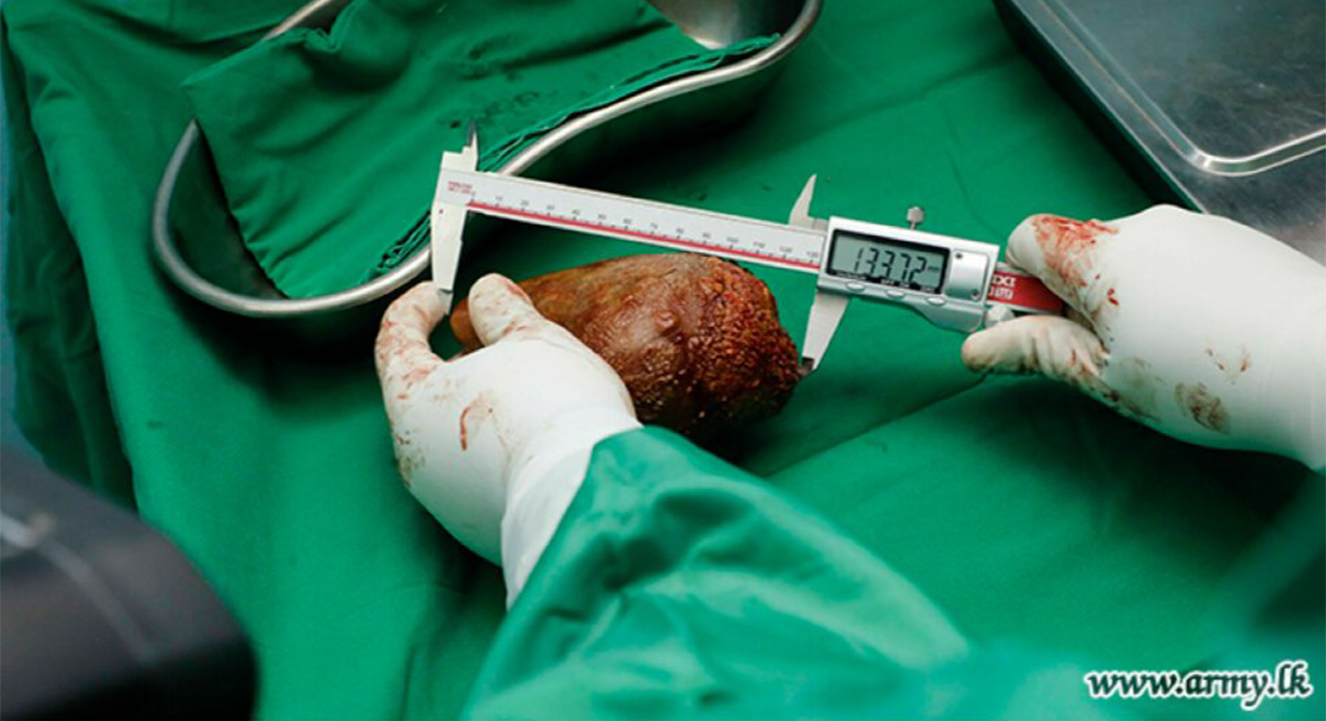 На Шрі-Ланці видалили найбільший у світі камінь з нирки вагою майже кілограм! (фото)