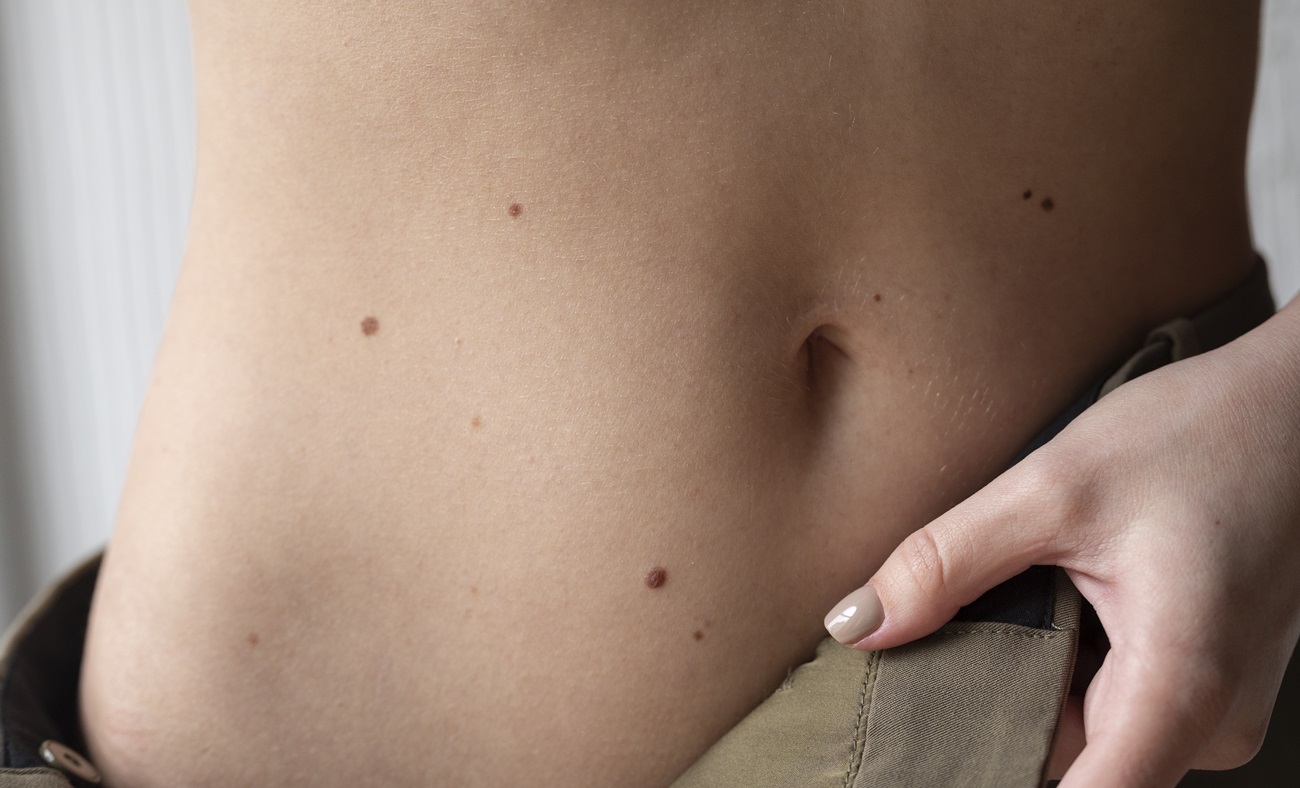 "Поціловані" щастям: ці родимки на тілі та обличчі приносять удачу