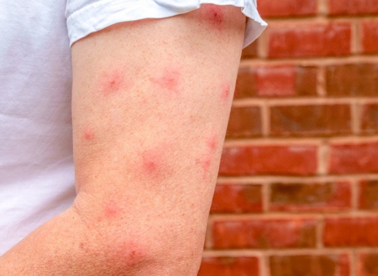 Українців атакують мокреці: чим небезпечні ці комахи