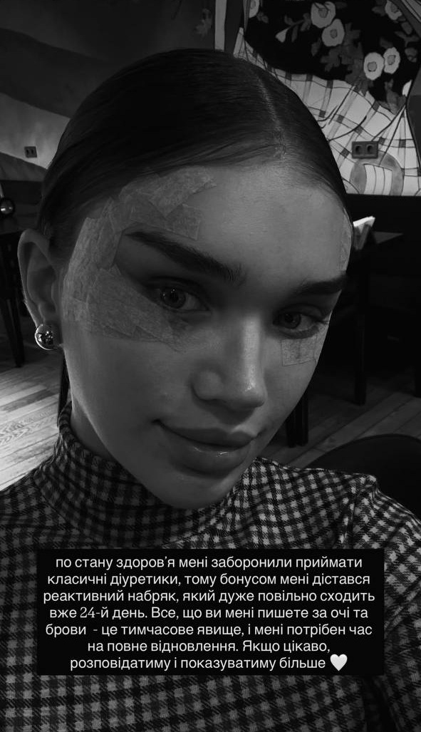 Саша Бо поскаржилася на ускладнення після омріяної "пластики": фото до та після