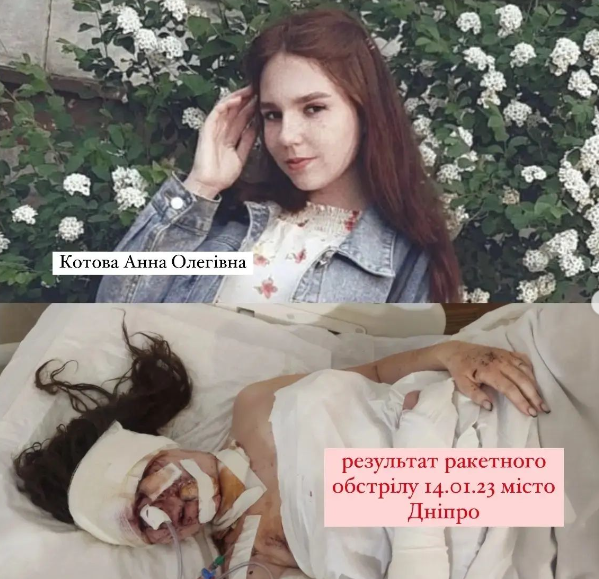 В тот день праздновала 19-летие: в Днепре девушка осталась без глаза из-за удара РФ по дому
