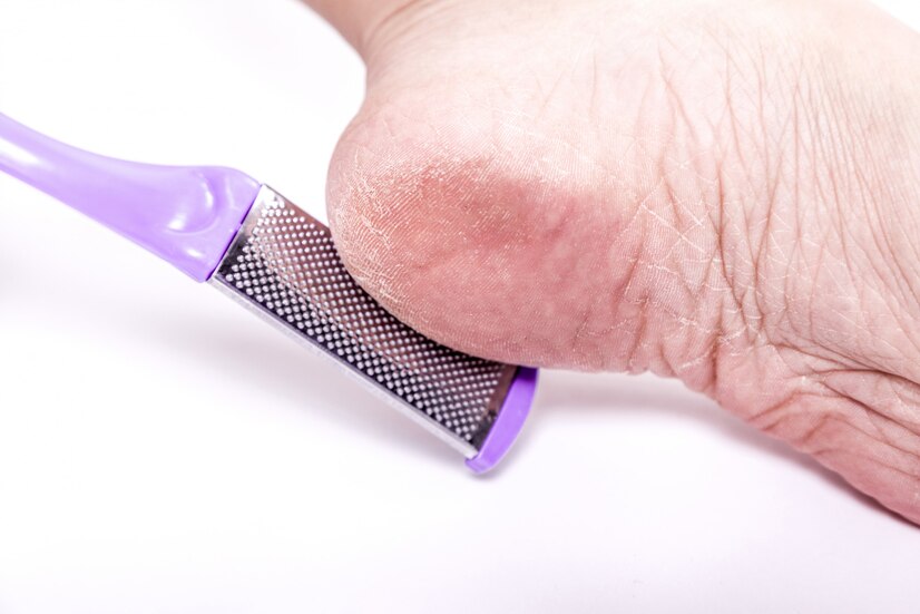 Названо найгіршу пилочку для п'ят, яку ніколи не можна використовувати