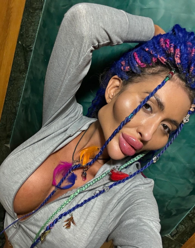 Українка з найбільшими вилицями зробила ще одну "пластику" та показалася після наркозу (фото)