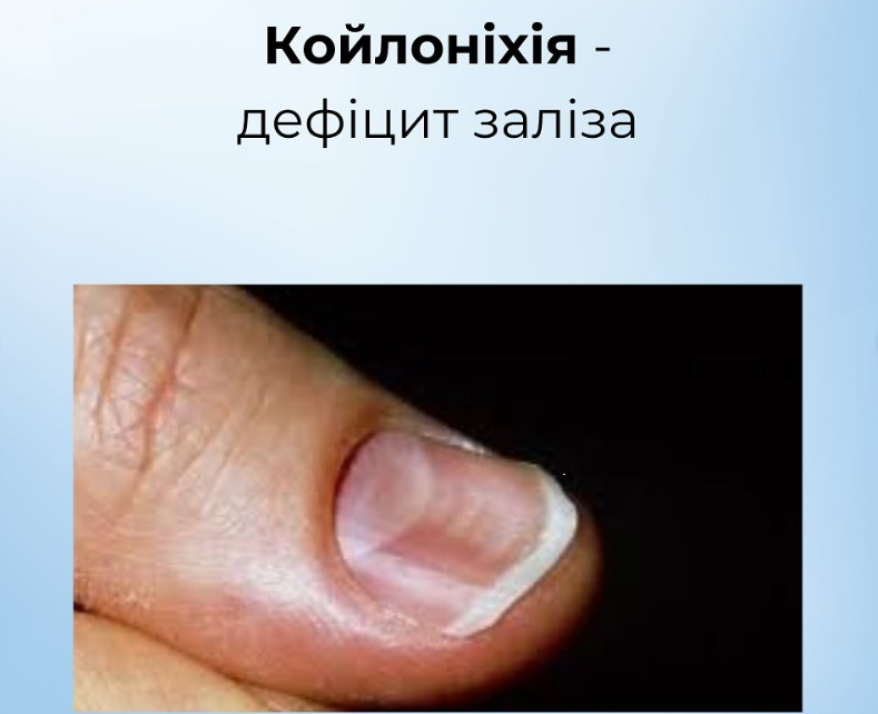 На проблему вкажуть нігті: як розпізнати харчові дефіцити й повернути собі здоров'я