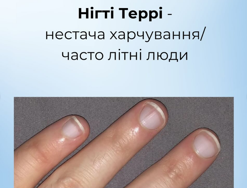 На проблему вкажуть нігті: як розпізнати харчові дефіцити й повернути собі здоров'я