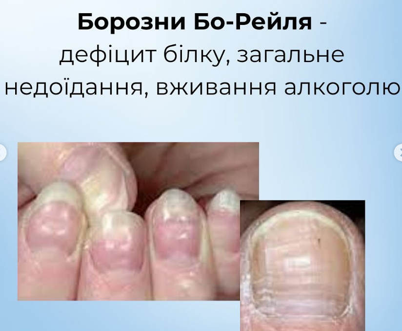 На проблему вкажуть нігті: як розпізнати харчові дефіцити й повернути собі здоров'я