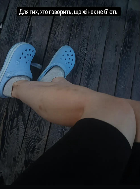 Слідча з Маріуполя показала фото з наслідками полону та звернулася до росіян з "побажанням"