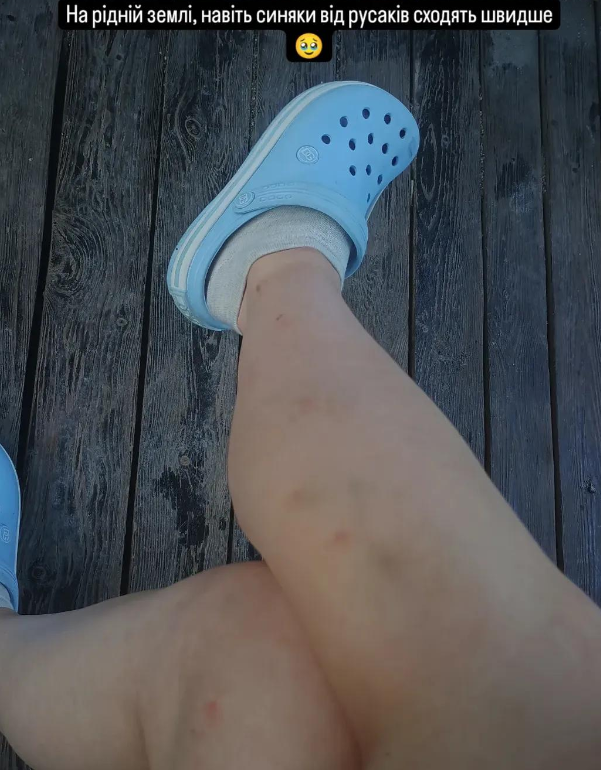 Слідча з Маріуполя показала фото з наслідками полону та звернулася до росіян з "побажанням"