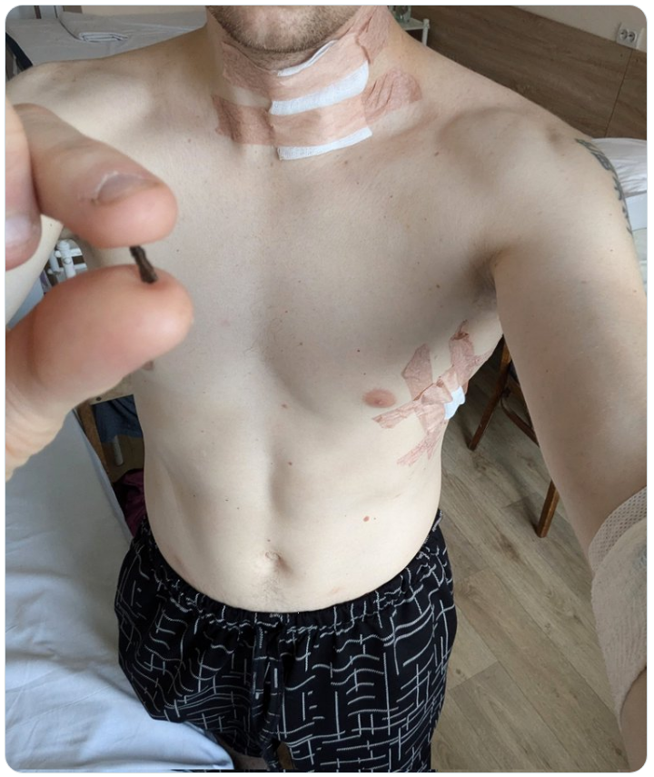 Журналіст і колишній політв'язень Кремля Станіслав Асєєв отримав поранення на фронті