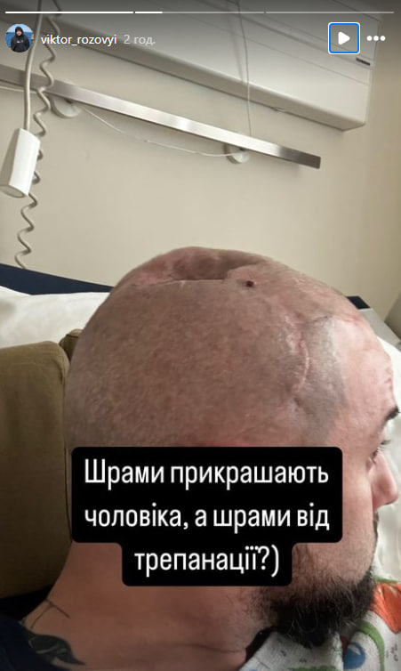 Зірка "Ліги сміху" Розовий показав шрами від трепанації після поранення на фронті (фото)
