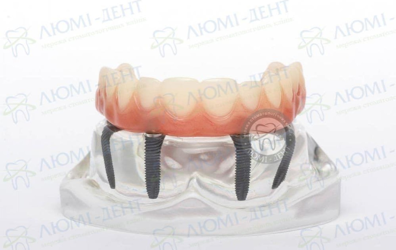 Імплантація зубів при захворюваннях ясен: фахівці розповіли, що може стати на заваді