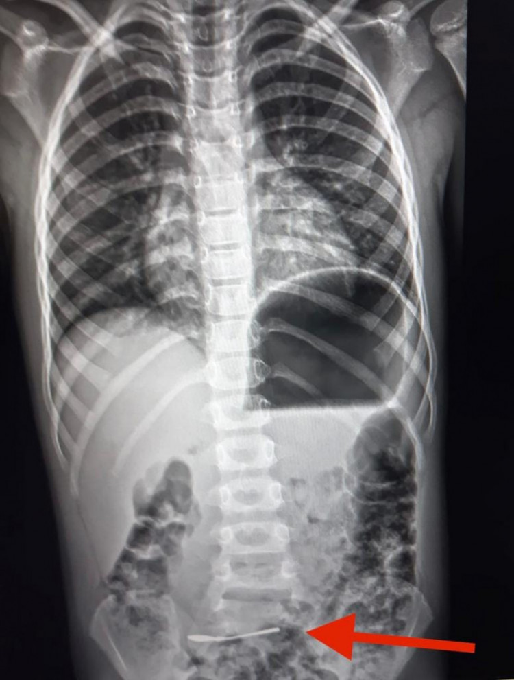 В Харькове ребенок проглотил ложку: что сделали врачи