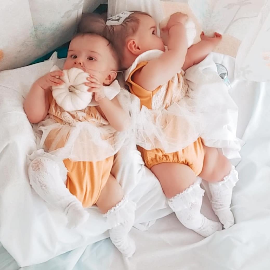 Украинка родила сросшихся близнецов, которым давали минимальные шансы выжить: как они выглядят сейчас