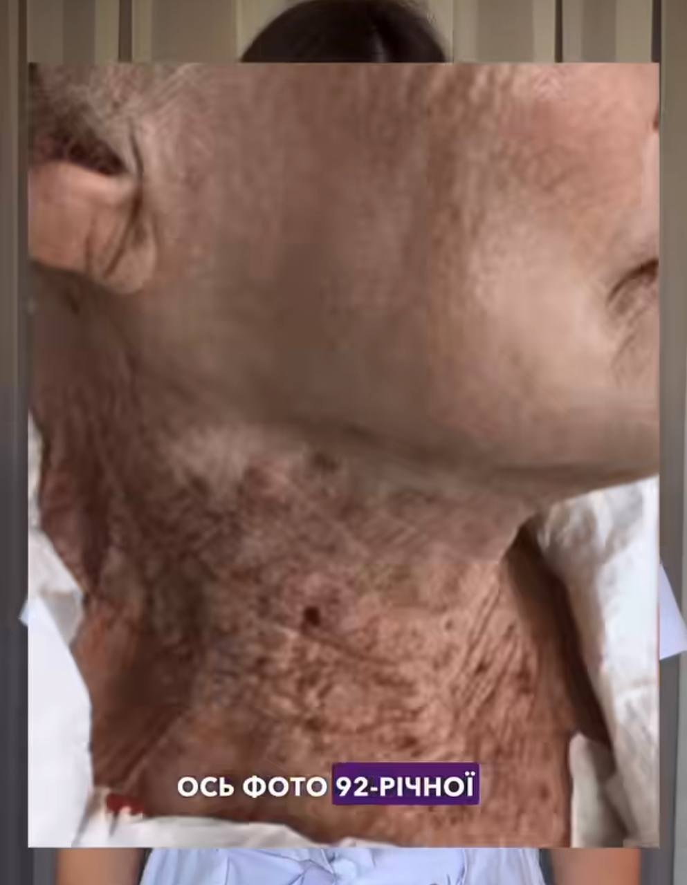 Що станеться з шкірою, якщо не користуватись SPF-кремом восени: фотоприклади