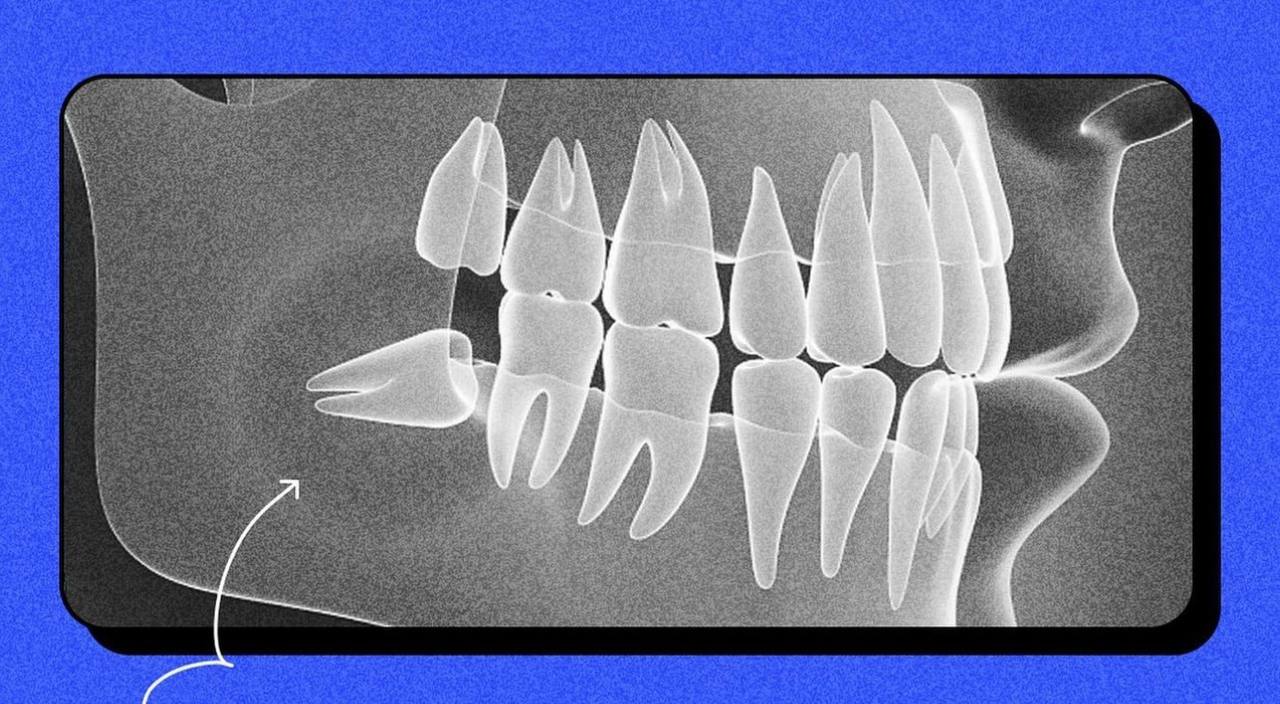 Чи завжди потрібно видаляти зуби мудрості: вся правда про "вісімки"