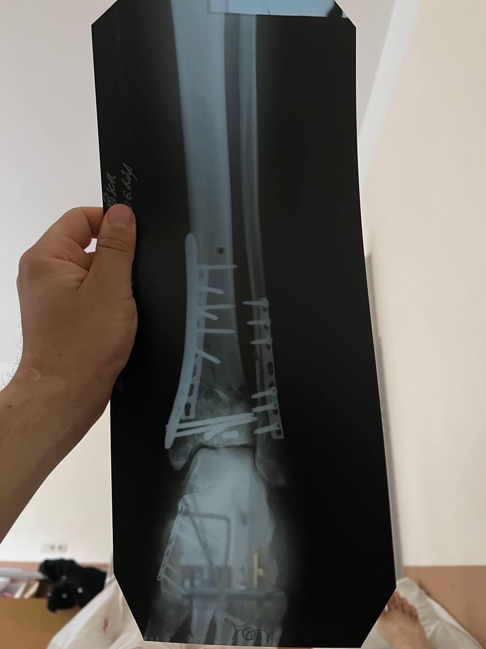 "Росія хоче, щоб ми всі покинули рідну країну і забули свою історію". Доброволець ЗСУ дивом вижив після поранення