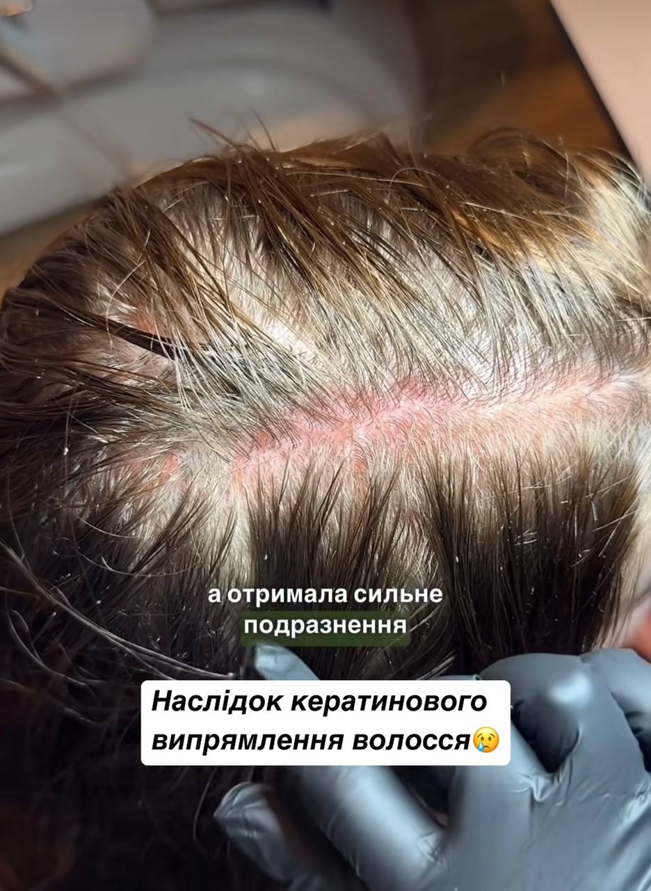Сильний опік і випадіння. Трихолог показала наслідок кератинового випрямлення волосся (фото)