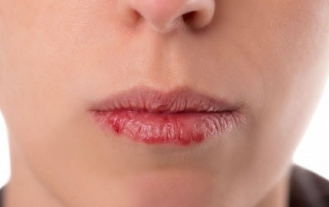 Три простих кроки, щоб ніколи більше не мати тріщин на губах