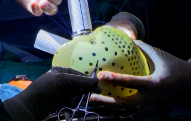 В США трансплантировали полностью искусственное четырехкамерное сердце