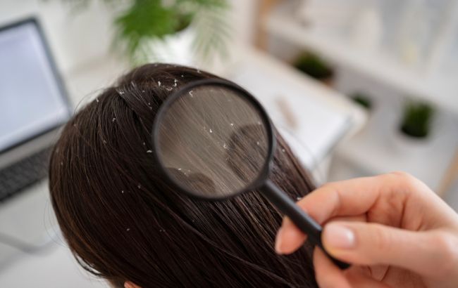 Три помилки у догляді за волоссям, які призводять до лупи: ніколи їх не робіть