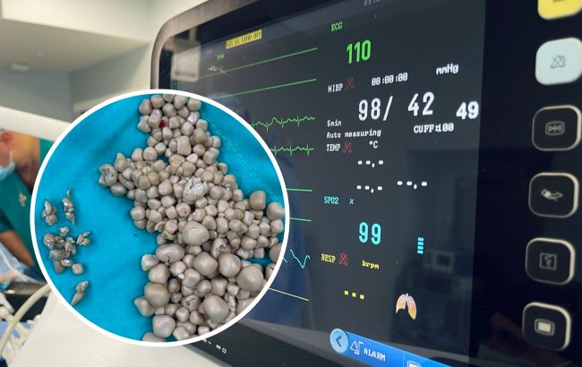 Лікарі дістали з нирок жінки 300 каменів. Все через її нелюбов до одного напою