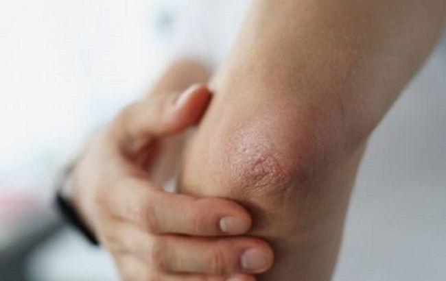 Як позбутися сухості та тріщин на ліктях: прості поради для здорової шкіри