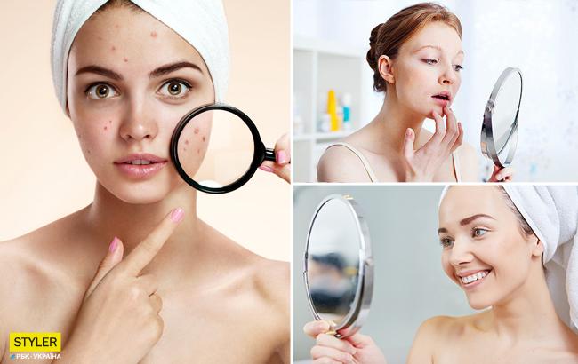 Топ-5 основных причин появления прыщей