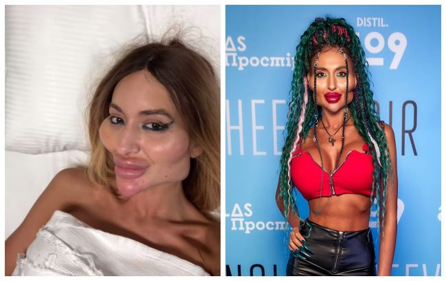 "Шкіра бовтається": українка з найбільшими вилицями схудла на 12 кг та перенесла ще одну "пластику"