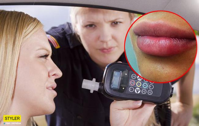 Из-за коллагеновых губ девушка не прошла алкотестер