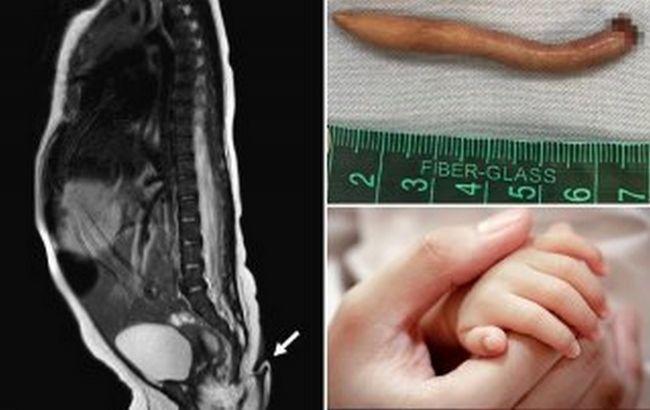 В Мексике родилась уникальная девочка: врачи обнаружили у нее хвост