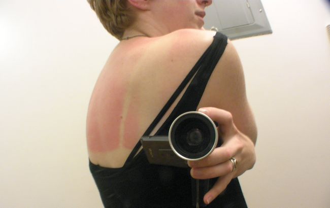 Забудьте про олію та сметану. Лікар розповіла про першу допомогу при сонячних опіках