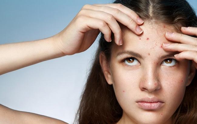 Топ-5 помилок, які провокують появу акне