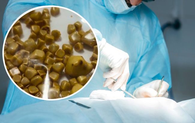 Удалили более 100 камешков: на Волыни спасли жизнь женщине