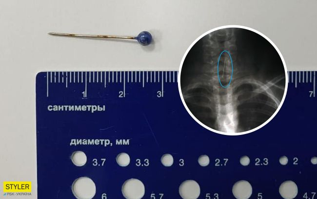 В Днепре ребенок проглотил булавку: врачи спасли необычным способом (фото)