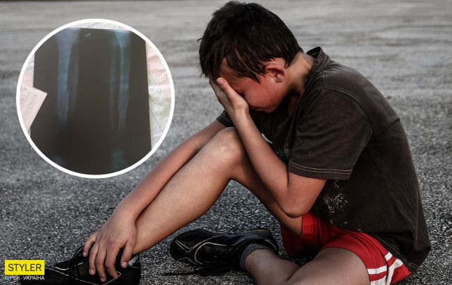 Плакал от боли: под Одессой учительница сказала вынести за территорию школы ребенка со сломанной ногой