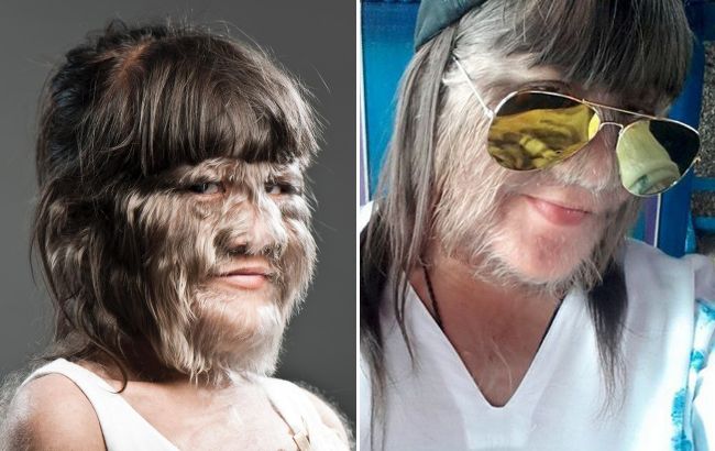 Від "дівчинки-вовчиці" до впевненої жінки: історія незвичайної рекордсменки книги Гіннеса