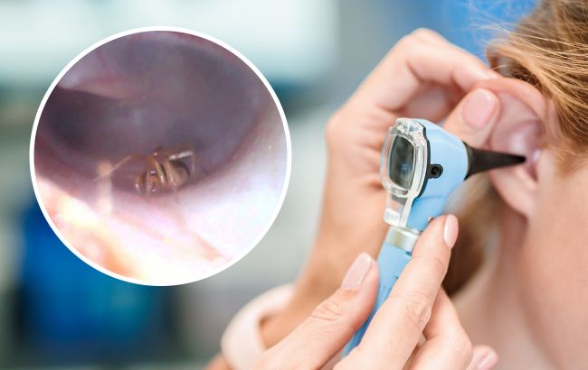 "Цікава знахідка": під Тернополем у вусі 4-річного хлопчика виявили павука