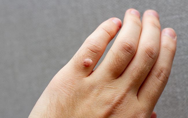 Лікар розповіла, як лікувати бородавки вдома і які з них щезнуть самостійно