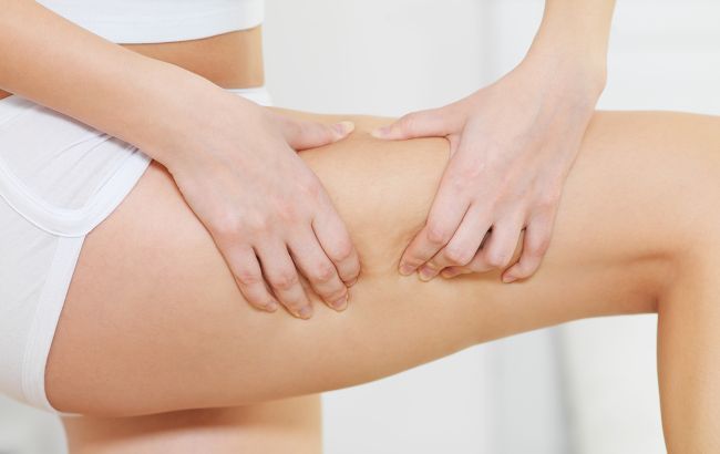 Чим небезпечний целюліт і як його прибрати? Відповідь лікаря