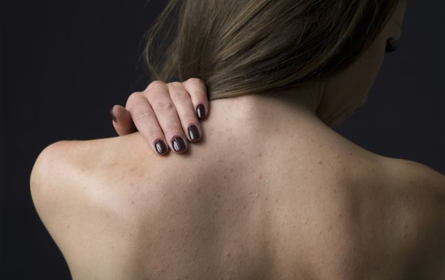 Появляются прыщи на спине? Эти способы помогут избавиться от них навсегда